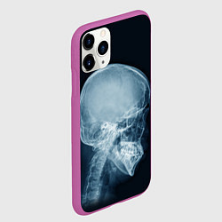 Чехол iPhone 11 Pro матовый Рентген головы, цвет: 3D-фиолетовый — фото 2
