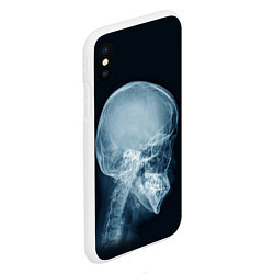 Чехол iPhone XS Max матовый Рентген головы, цвет: 3D-белый — фото 2